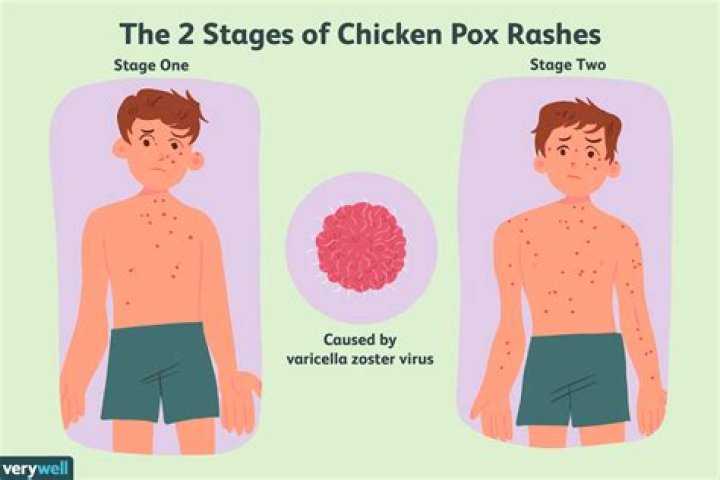 Can we eat egg in chicken pox